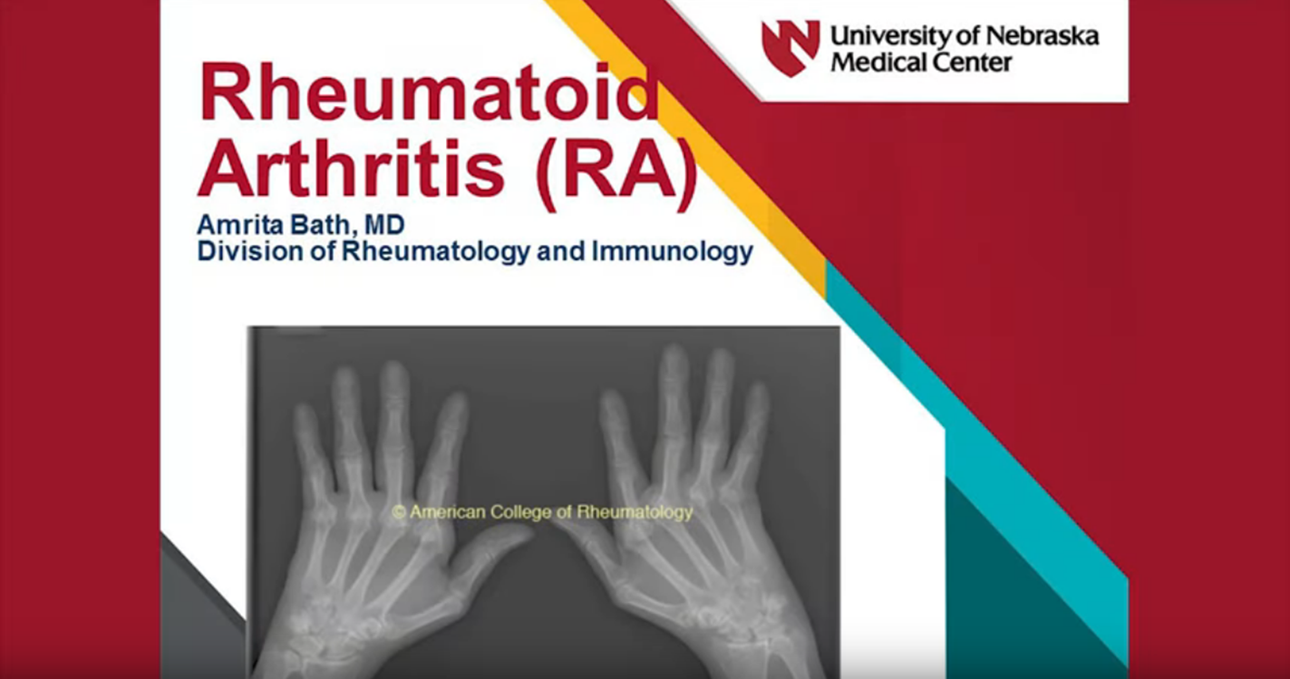     Rheumatoid Arthritis
