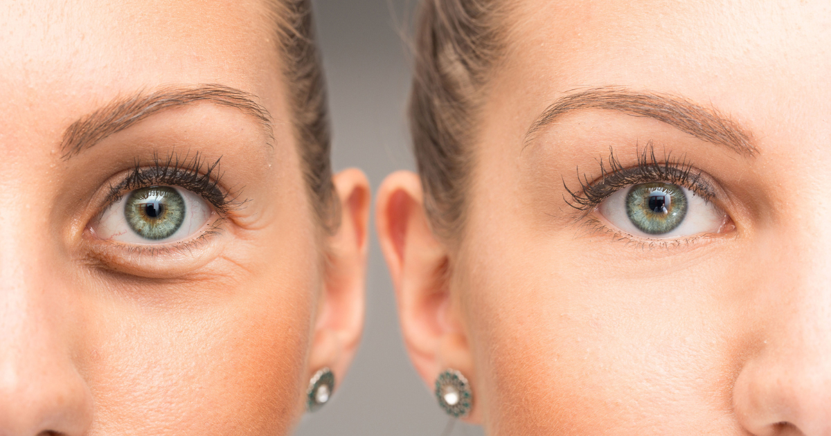 Before and after of eyelid surgery