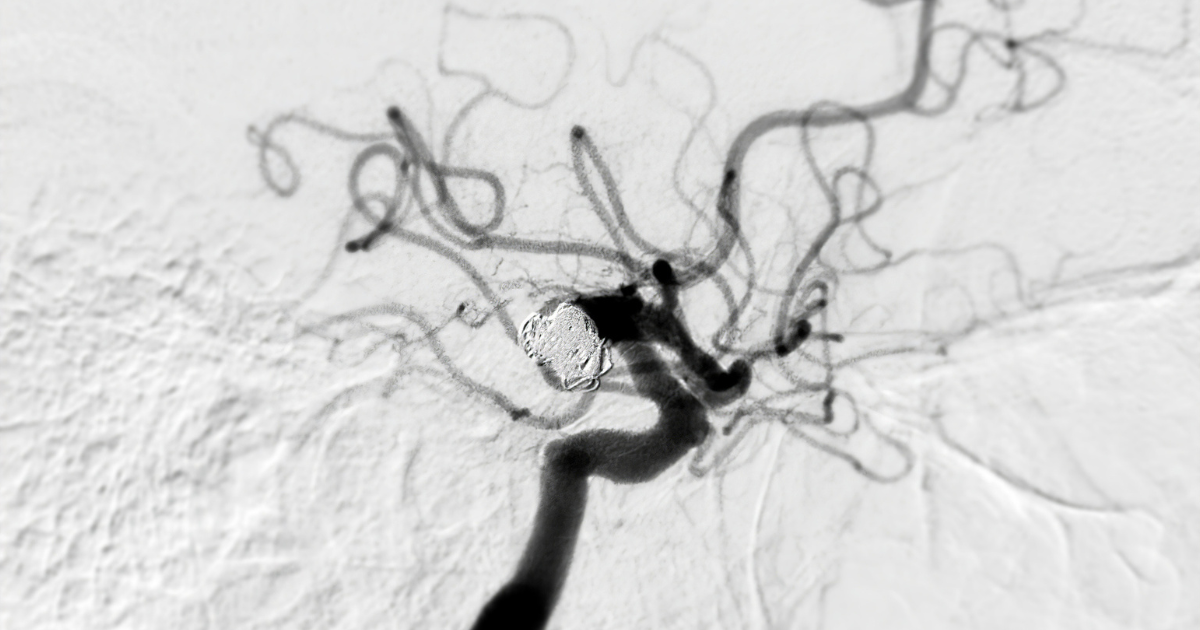 Endovascular coiling during a cerebral angiogram shows the precision required for treating vascular conditions.