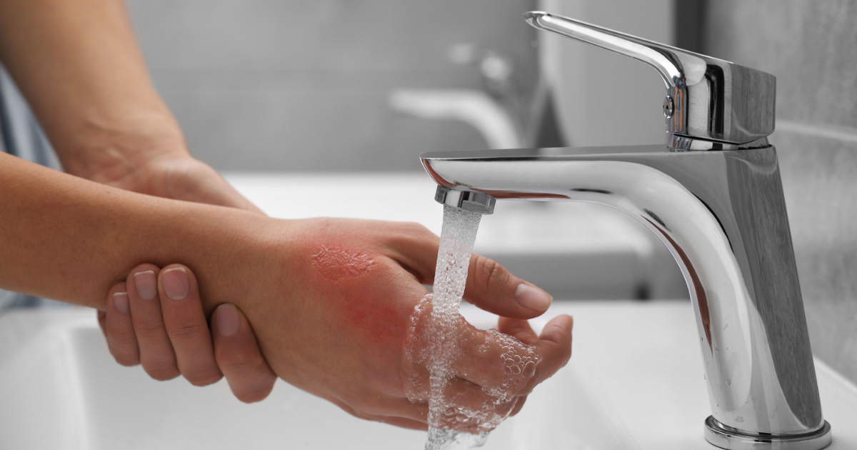 Woman holding burned hand under running faucet