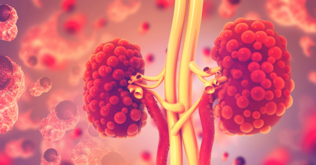 Medical illustration of diseased kidneys