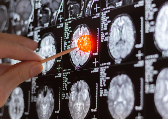 Close up of hand pointing at brain scan
