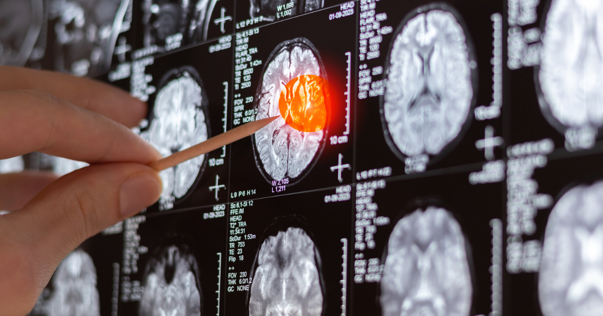 Brain and spine cancer therapeutics only offered by Nebraska Medicine