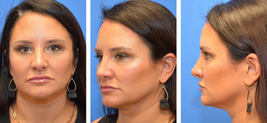 Patient After, front, 45 degrees and side angle