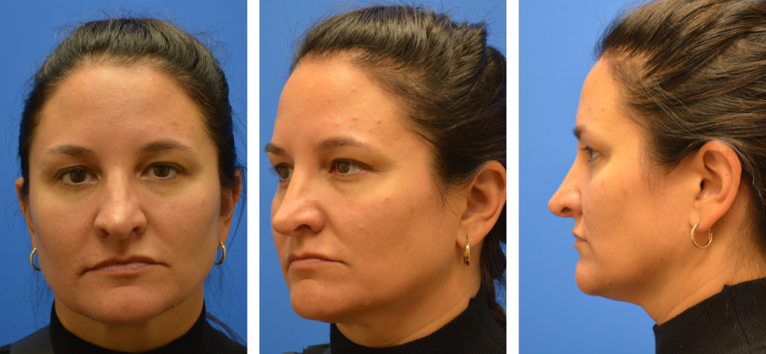 Patient before, front, 45 degrees, side angle