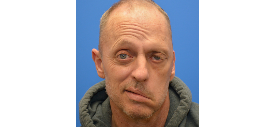 facial paralysis patient before photo