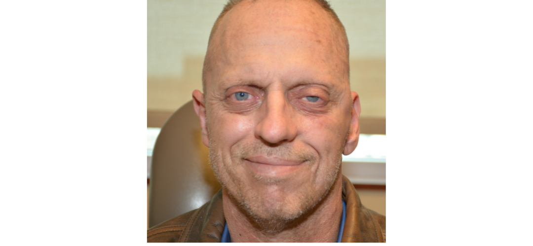 facial paralysis patient after photo