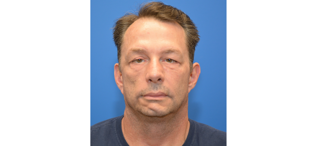 patient facial paralysis after