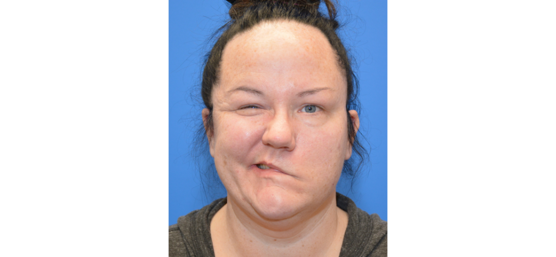 Facial paralysis patient before