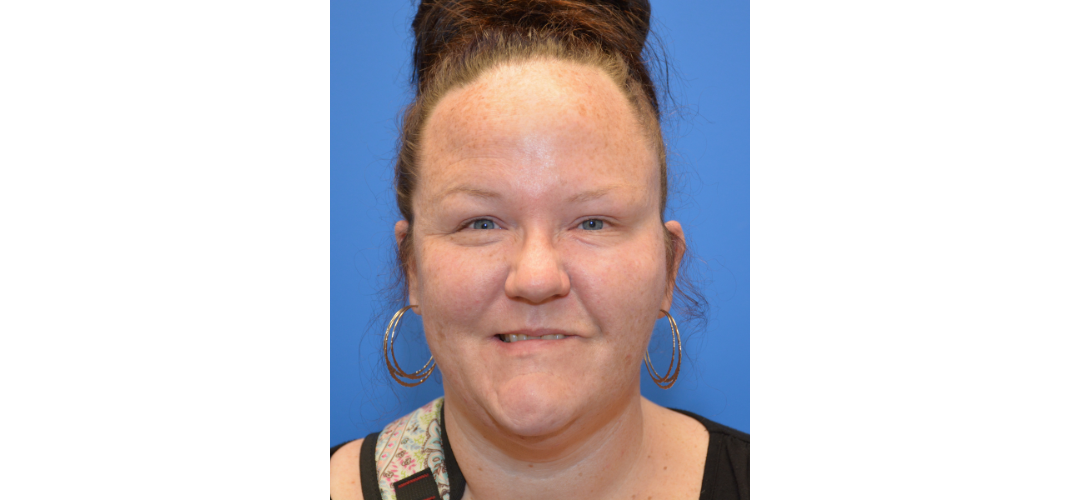 Facial paralysis patient after