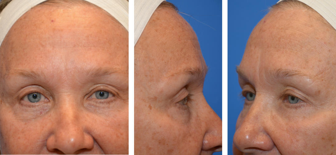 Patient after photo, front, side and 45 degree angle