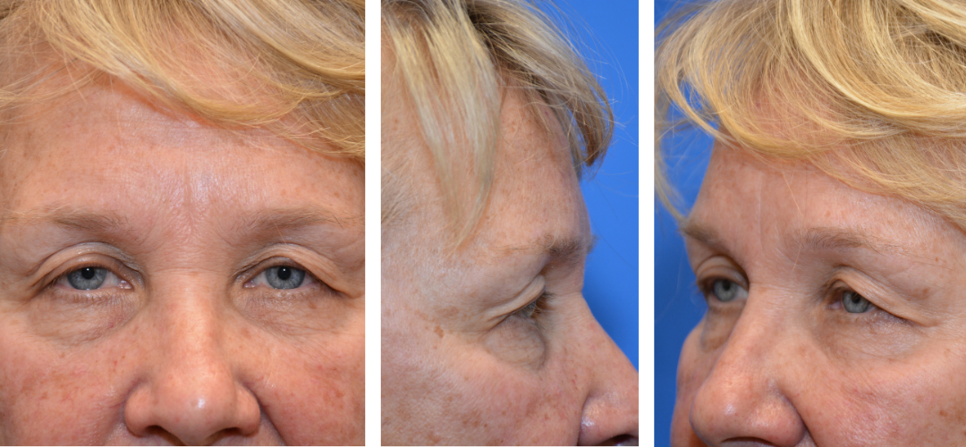 Patient before photo, front, side and 45 degree angle