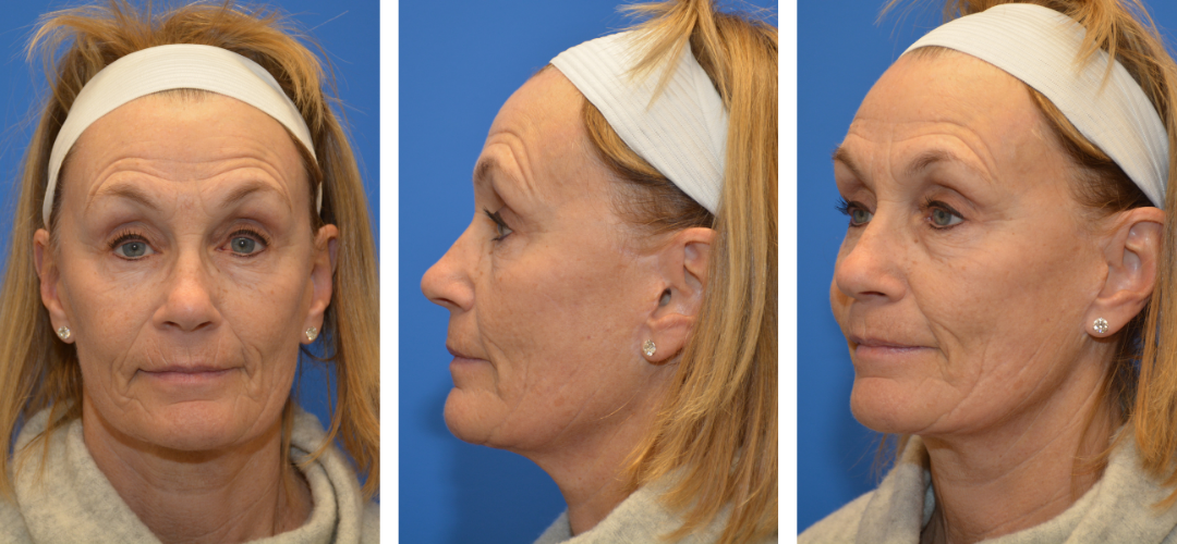 Patient after photo, front, side, 45 degree angle