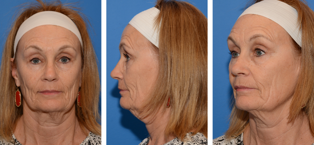 Patient before photo, front, side, 45 degree angle