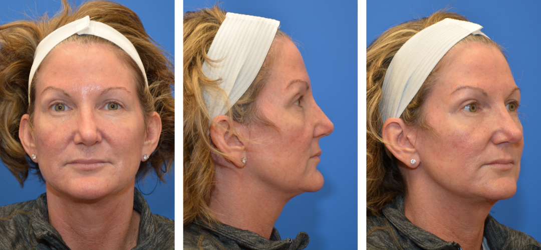 Patient after photo, front, side, 45 degree angle