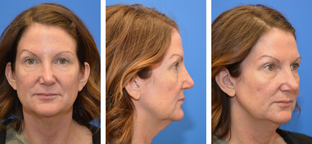 Patient before photo, front, side, 45 degree angle