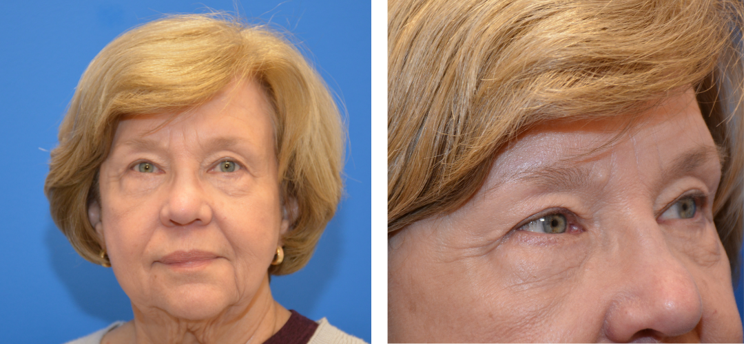 Patient after front and side