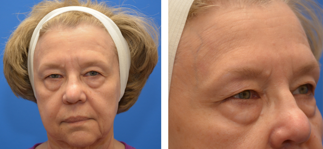 Patient before front and side