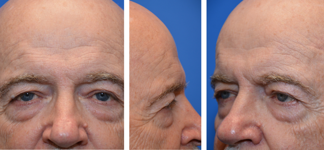 Patient before, front, side, 45 degree angle