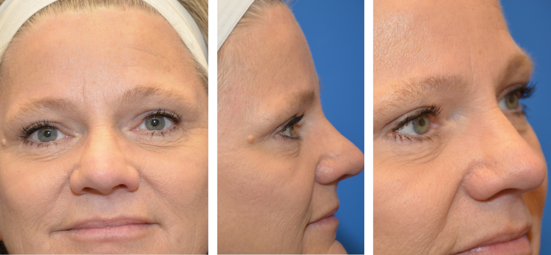 Patient After, front, side and 45 degree angle