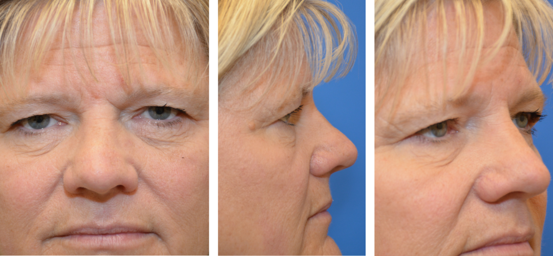 Patient Before, front, side, 45 degree angle