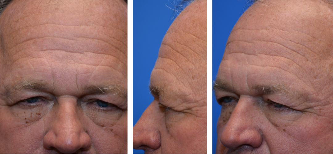 Patient before, front, side, 45 degree angle