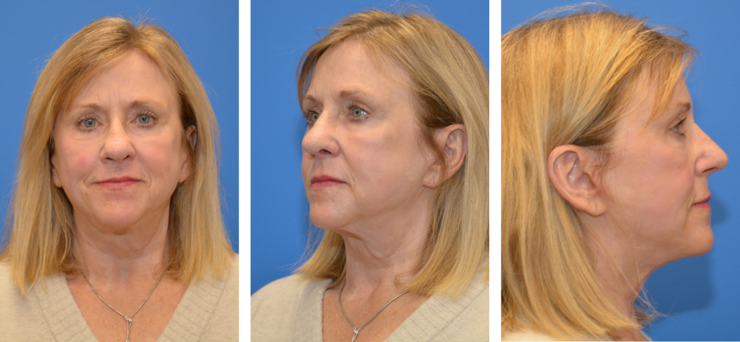 Patient after photo, front, side and 45 degree angle