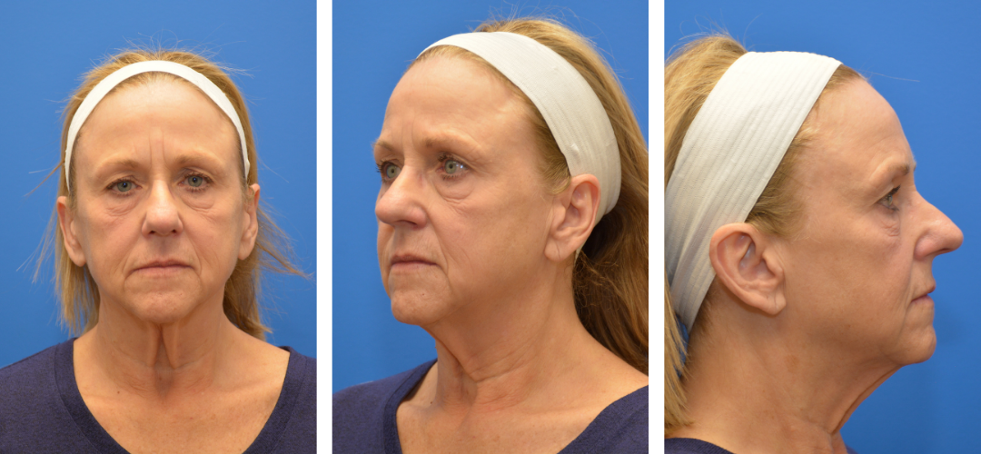 Patient Before photo, front, side and 45 degree angle