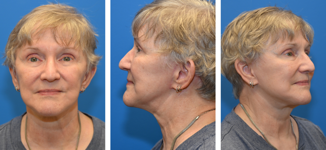 Patient after photo, front, side and 45 degree angle