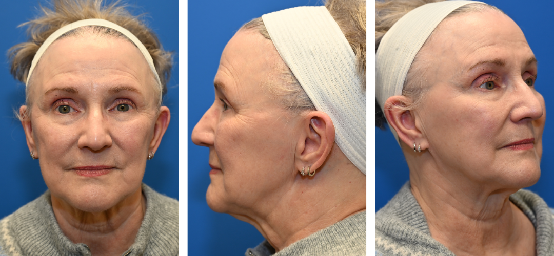 Patient Before photo, front, side and 45 degree angle