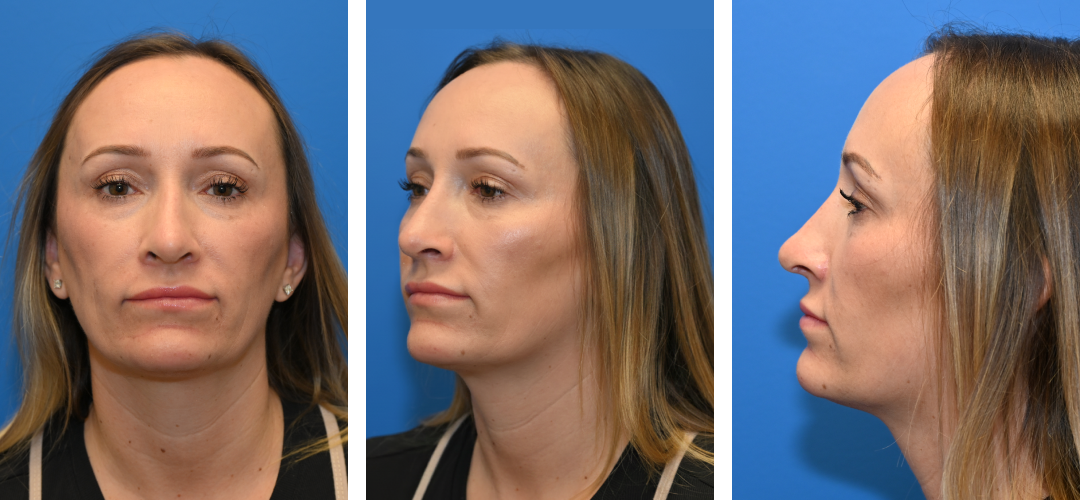 Three different angles of a woman after a Revision rhinoplasty.