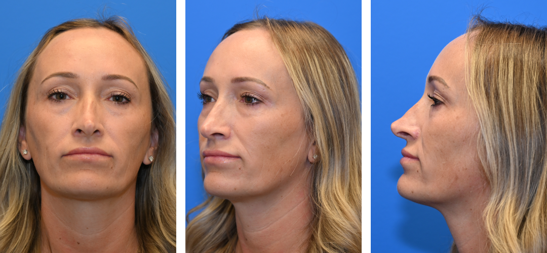 Three different angles of a woman before a Revision rhinoplasty.