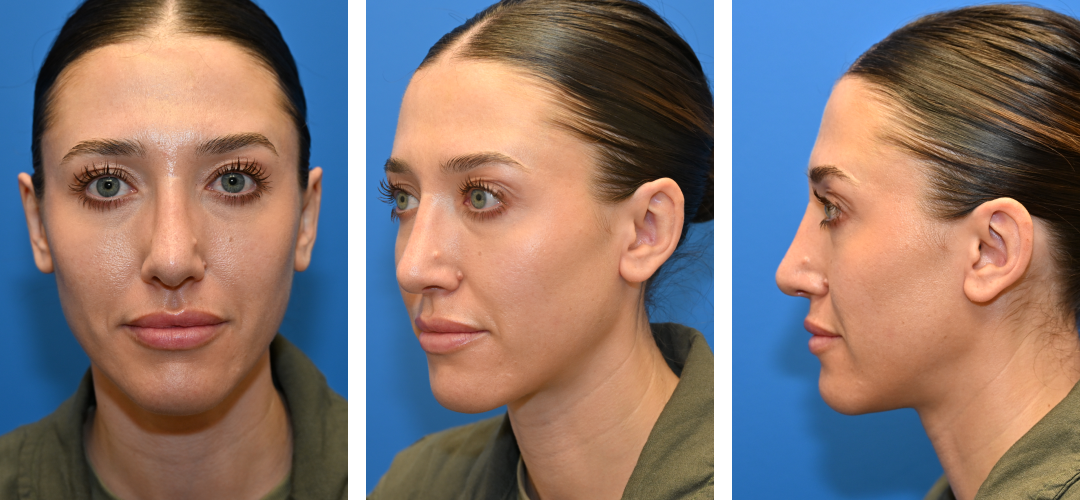 Three angles of a woman's face after rhinoplasty