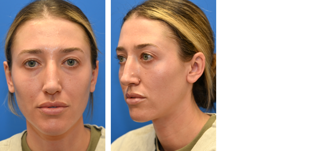 Three angles of a woman's face before rhinoplasty