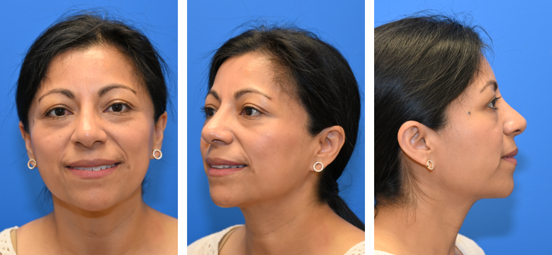 Three angles of a woman's face after rhinoplasty.