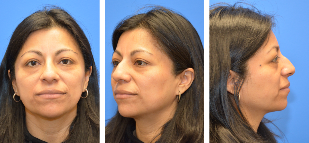 Three angles of a woman's face before rhinoplasty.
