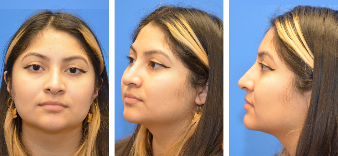 Three angles of a woman's face after rhinoplasty.