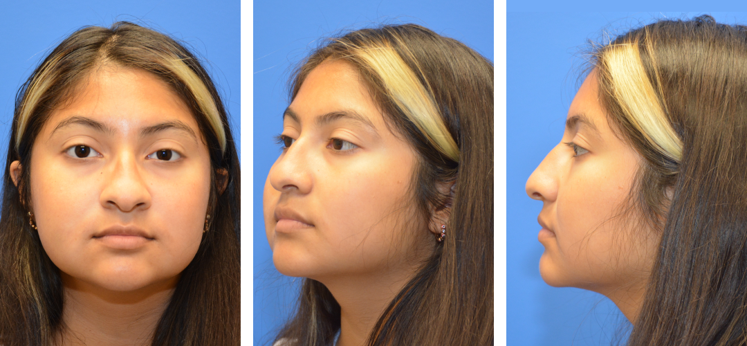 Three angles of a woman's face before rhinoplasty.