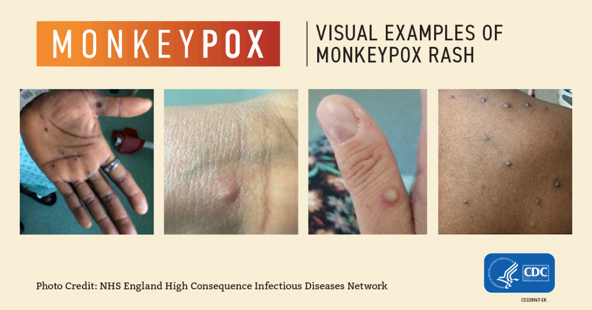 Monkeypox visual