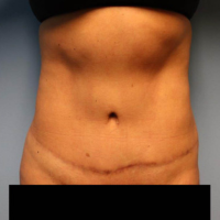 After the photo of a woman doing a tummy tuck