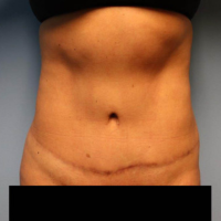 After photo of a woman who had a tummy tuck