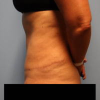 After photo of a woman who had a tummy tuck