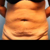 Before photo of a woman who had a tummy tuck