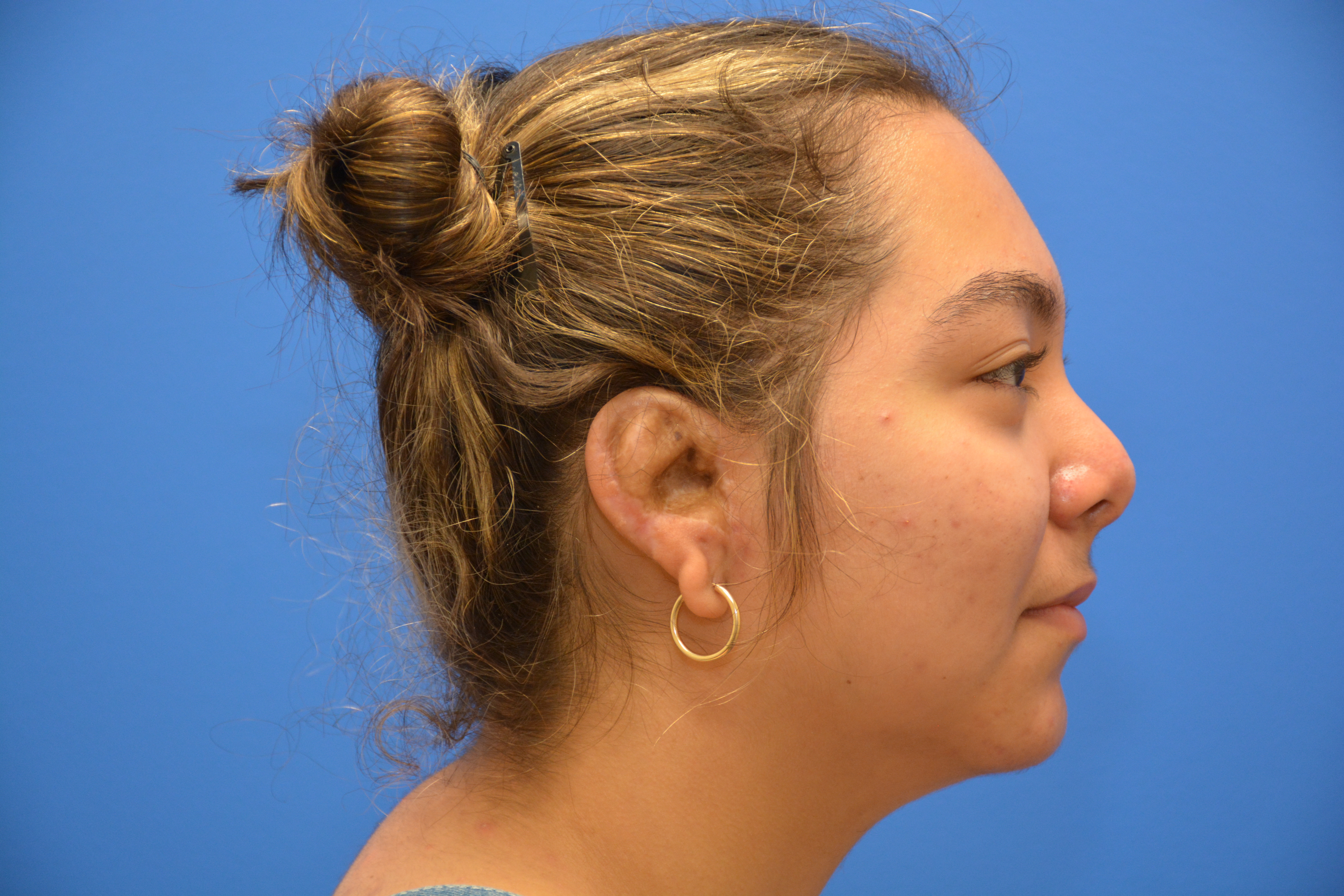 After: Photo taken 12 months after surgery.