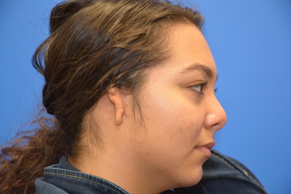 Before: Congenital ear deformity (microtia)