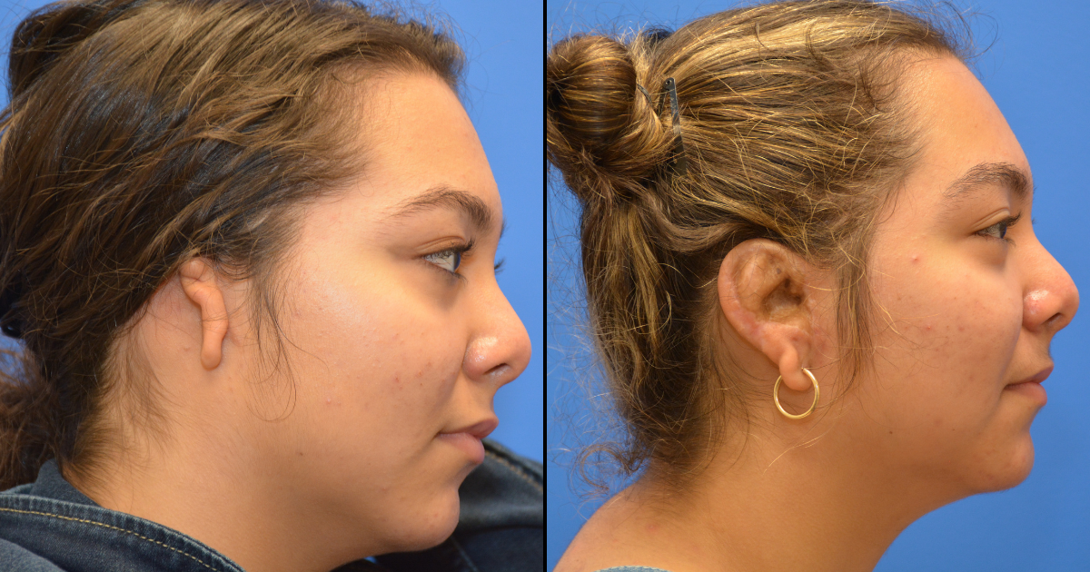 Before and after of woman with congenital ear deformity (microtia)
