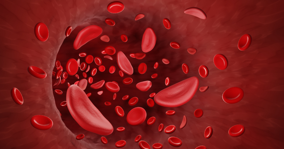 Medical illustration of a sickle cell