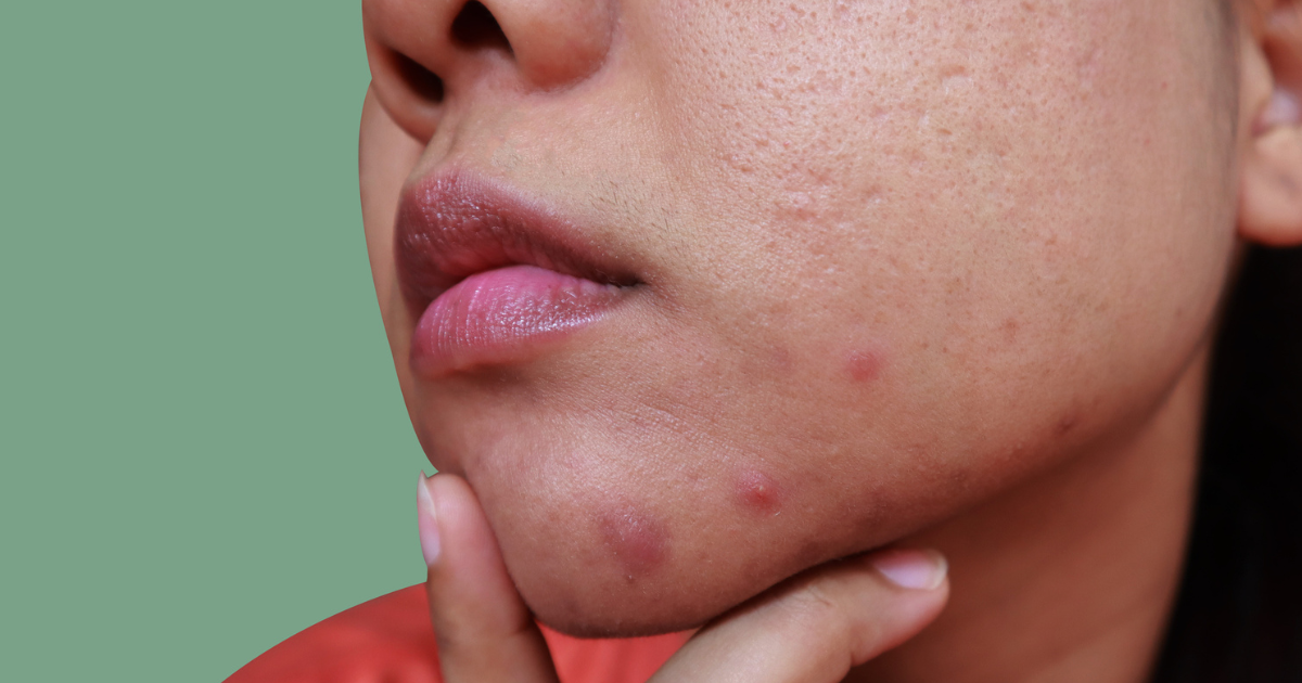 Close up of a woman's face with acne