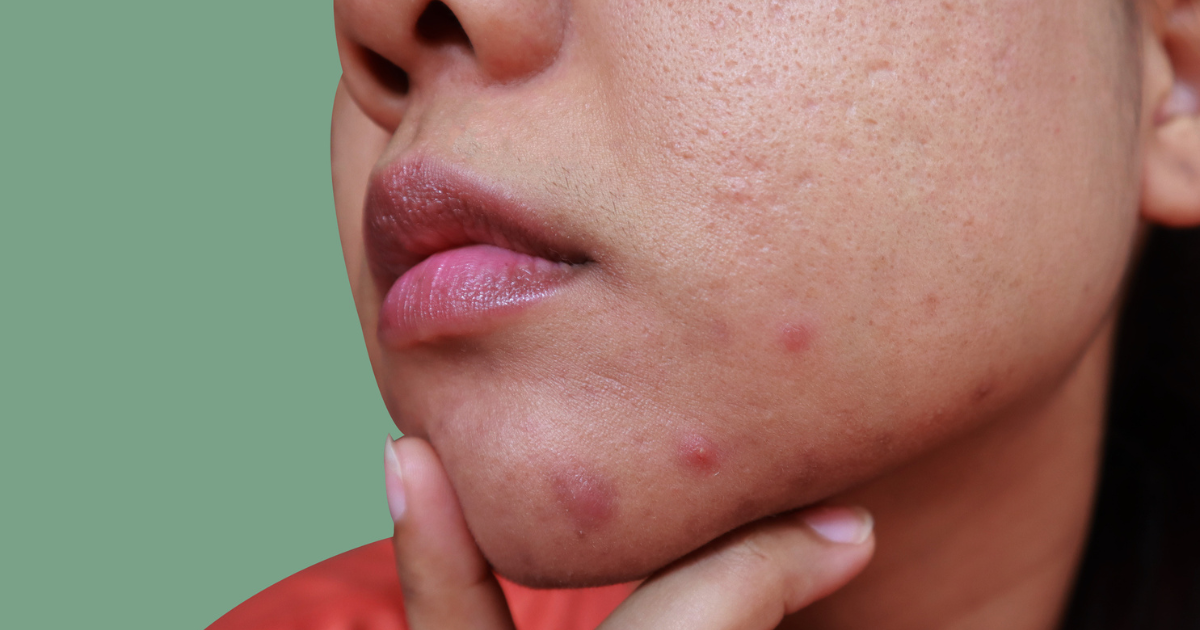 polycystic ovarian syndrome acne