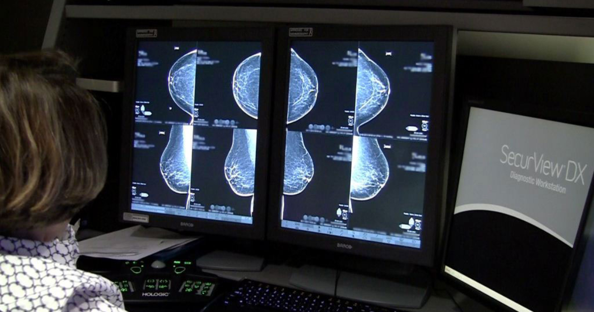3D mammogram